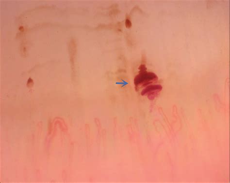 Nailfold Capillaroscopy Alterations In Androgenetic Alopecia A Cross