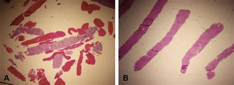 A Prospective Head To Head Comparison Of 2 Eus Guided Liver Biopsy