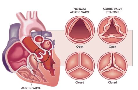 Strain Longitudinal E Estenose A Rtica Blog Ecope