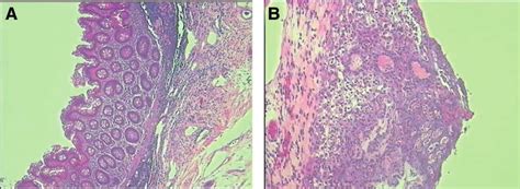 A And B Postoperative Pathological Analysis Of The Appendix Showed Download Scientific