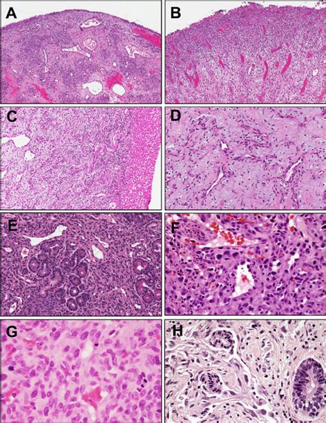 A Lobular Capillary Hemangioma Lch Demonstrates Distinctive Download Scientific Diagram