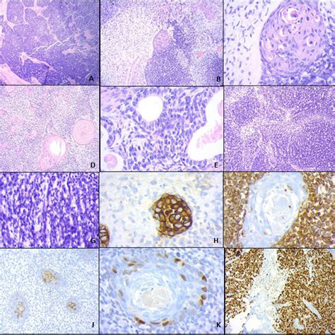 Aspecto Macroscópico Del Carcinosarcoma De Cérvix Tumor Localizado En Download Scientific