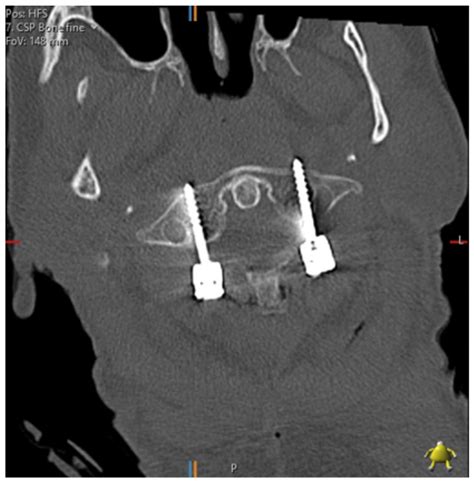 Tomography Free Full Text Cervical Spine Pedicle Screw Accuracy In