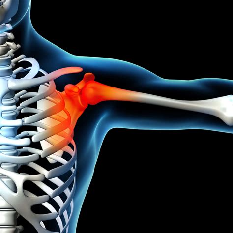 Shoulder Pain Novus Spine Pain Center Lakeland Florida