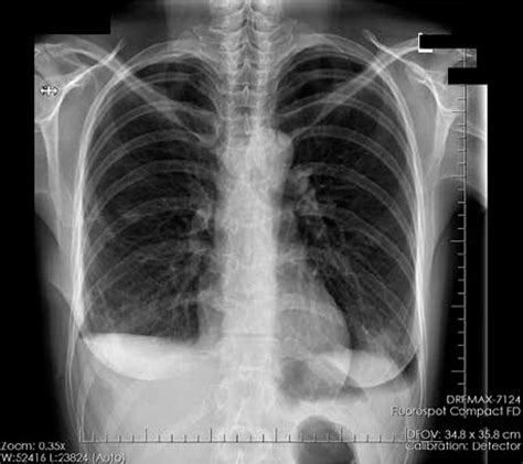 Catamenial Pneumothorax Are There Benefits Of Cooperation Between The