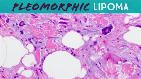 Pleomorphic Lipoma Spindle Cell Lipoma Basic Soft Tissue Pathology