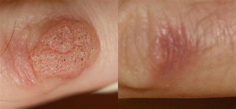 Laser Wart Removal Main Features And Peculiarities Med Warts