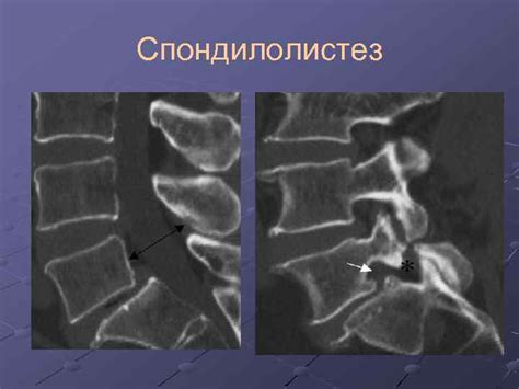 ЛУЧЕВАЯ ДИАГНОСТИКА ДИСТРОФИЧЕСКИХ ЗАБОЛЕВАНИЙ ПОЗВОНОЧНИКА Тащилкин А. И.