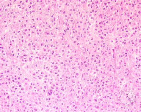 Cutaneous Lesions In Systemic Mastocytosis 2