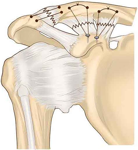 Acromioclavicular Joint Separation: Repair Through Suture Anchors for ...