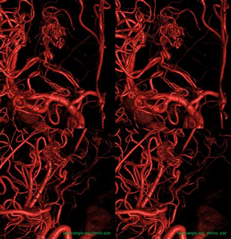 Posterior Choroidal Arteries