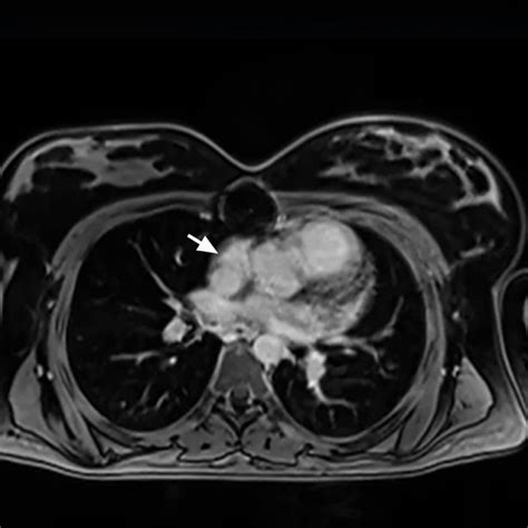 Cardiac Magnetic Resonance Image Shows A Sessile Mass Arrow Along The