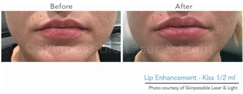 Lip Injections Dermapure Chaparral Formerly Skinpossible