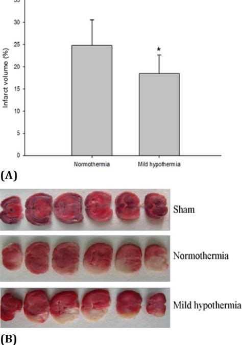 Effect Of Mild Hypothermia On Infarct Volume In Mcao Rats Infarct