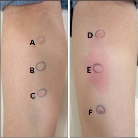 Intradermal Allergic Skin Test Results Showed Positive Reaction To 10 Download Scientific