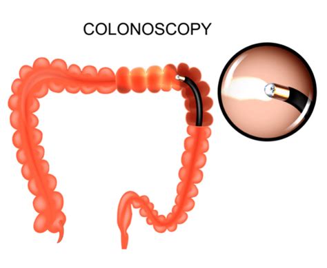 Screening Colonoscopy Cpt Code Dyane Grethel