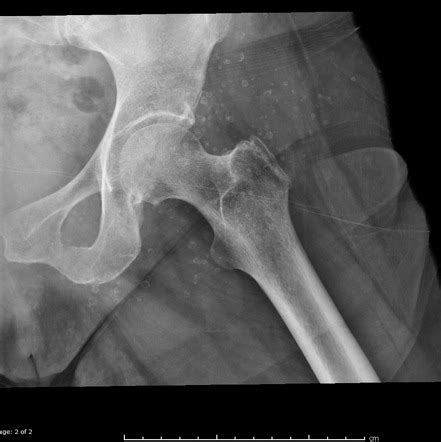 Soft Tissue Calcifications Hip Image Radiopaedia Org