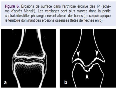 Arthropathies Interphalangiennes Distales Analyse L Mentaire Le