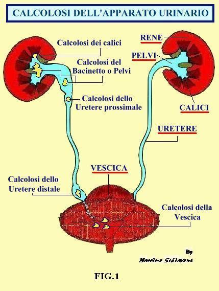 Calcolosi Renale Urologo Luigi Montano