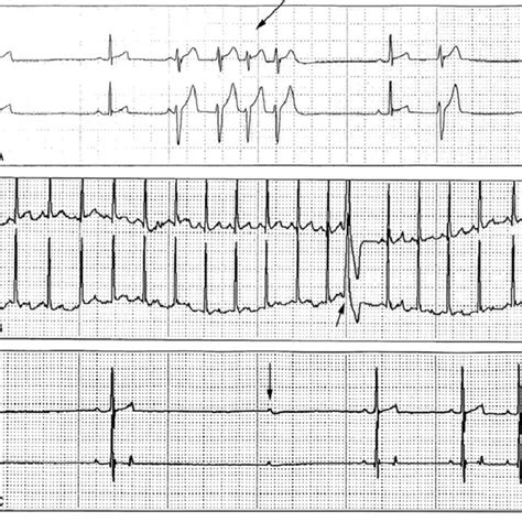 Electrocardiography -(A) Rapid ventricular ectopy seen in the 24 h... | Download Scientific Diagram