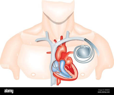 Vectores De Marcapasos Im Genes Vectoriales De Stock Alamy