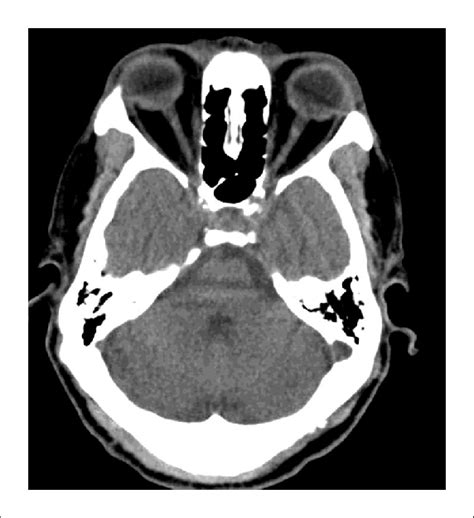 CT scan image following surgical excision of tumor showing mild... | Download Scientific Diagram