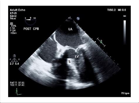 Two Dimensional Transesophageal Echocardiography Midesophageal Modified Download Scientific