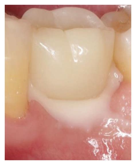 Stages Of Application Of A Customized Composite Abutment With Immediate