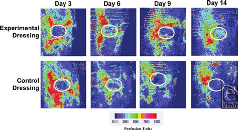 Laser Doppler Imaging Ldi Used To Quantify Perfusion Levels In