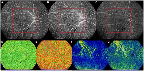 Frontiers Central And Peripheral Changes In The Retina And Choroid In