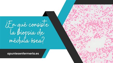 En qué consiste la biopsia de médula ósea Apuntes enfermería