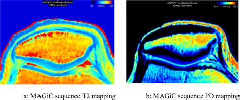 Difference In Quantitative Mri Measurements Of Cartilage Between Wiberg