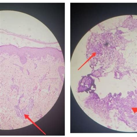 Histopathology Image Of Skin Showing Perivascular Lymphocytic