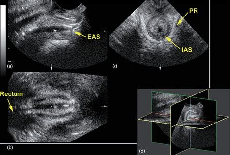 Anal Sphincter Disease Radiology Key