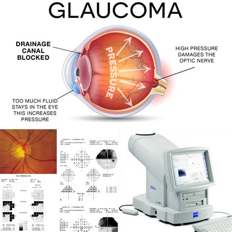 Treatment And Management Of Ocular Disease Hodes Vision Optometry