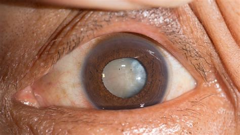 Brown Eyes With Blue Ring Around Iris