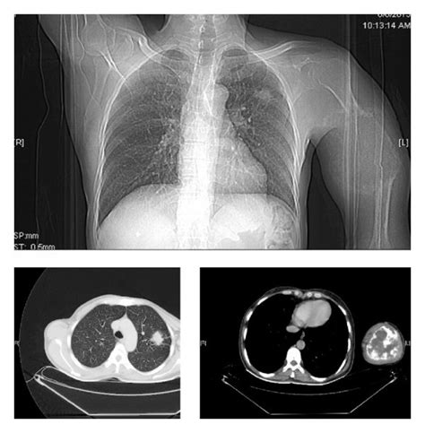 Cect Thorax Showing A Spiculated Nodule In The Left Upper Lobe With