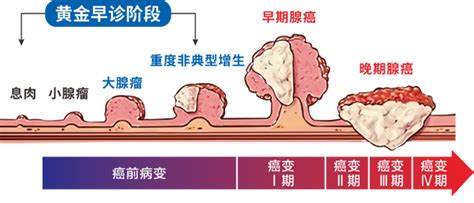 可能癌变的肠息肉，它曾发出这些信号提醒你 知乎