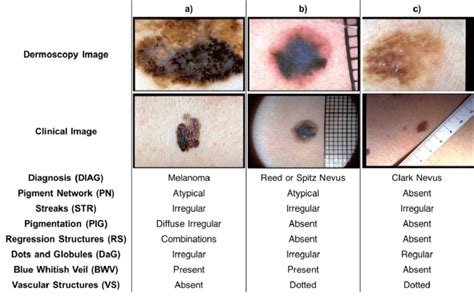 Blue Nevus Vs Melanoma