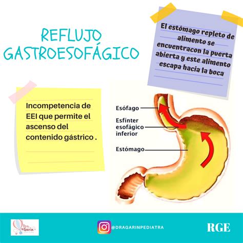 Reflujo gastroesofágico Dra Garín Pediatra