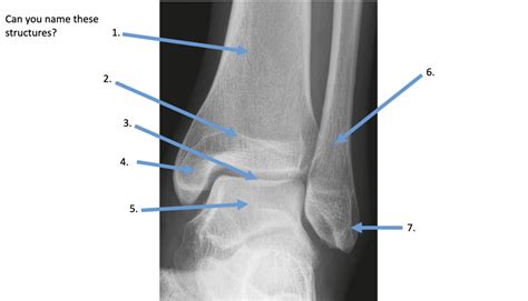 W Ankle Xray Diagram Quizlet