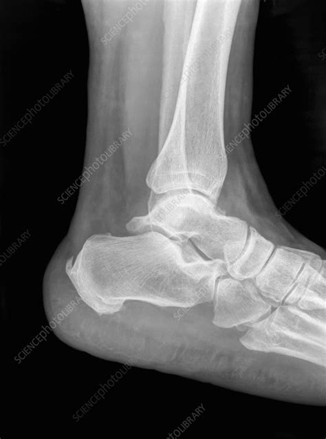 Ankle X Ray Stock Image C0564034 Science Photo Library