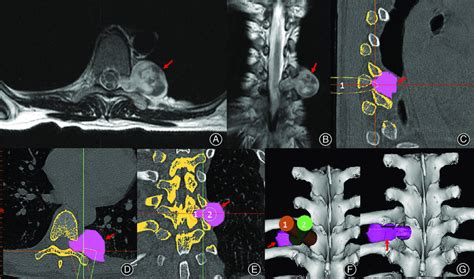 Preoperative T Weighted Mri On Axial A And Coronal B Planes