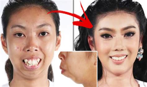 Plastic Surgery Transformation For Thai Woman Who Needs Chin Implant Uk