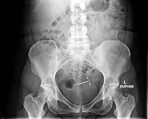 Abdominal Radiograph Shows The Intrauterine Device Projecting Over The