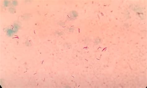 Mycobacterium Tuberculosis Gram Stain Color