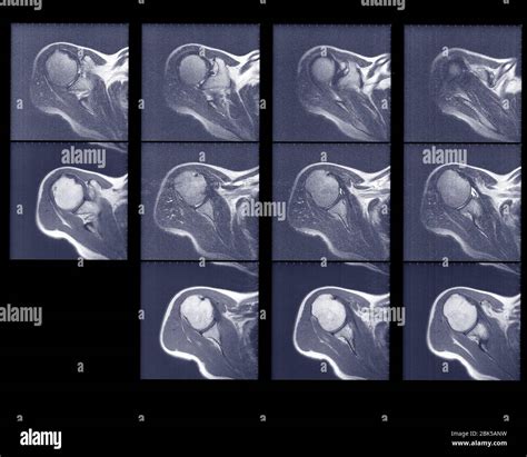 Multiple Scans Of Shoulder Joint Hi Res Stock Photography And Images