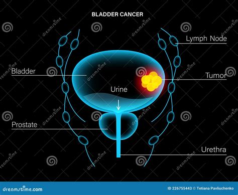 Bladder cancer stages stock vector. Illustration of ureter - 226755443