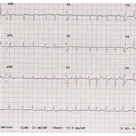 Twelve Lead Surface Electrocardiogram Showing Atrial Fibrillation With