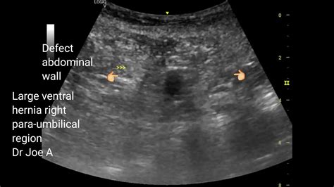 Ventral Hernia Ultrasound